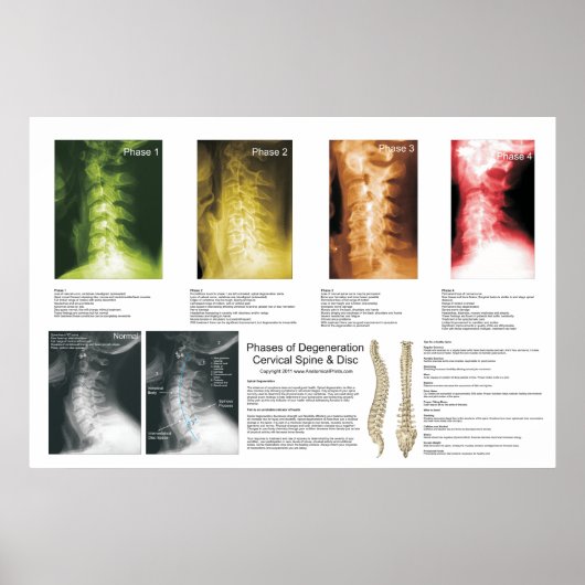 Phases Cervical Spinal Degenering Poster (Devant)