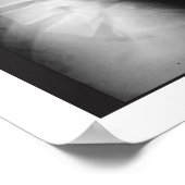 Phases Espagnoles Lumbar Affiche de dégénérescence (Coin)