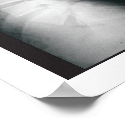 Phases Lumbar Spinal Degeneration Poster (Coin)