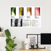 Phases Lumbar Spinal Degeneration Poster (Bureau à domicile)