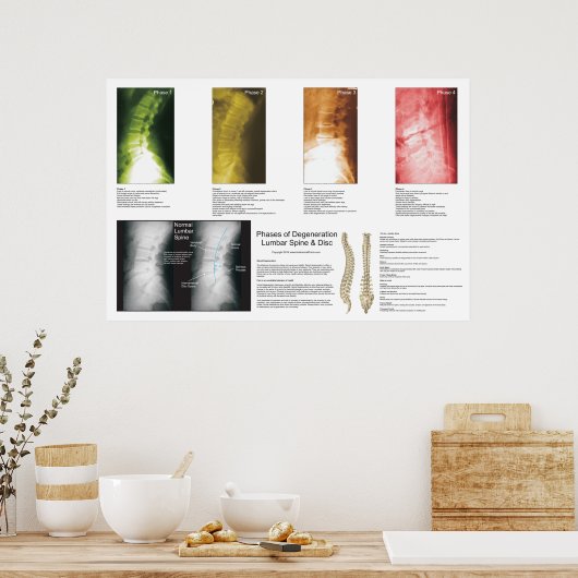 Phases Lumbar Spinal Degeneration Poster (Cuisine)