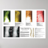 Phases Lumbar Spinal Degeneration Poster (Devant)