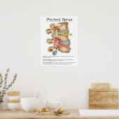 Pinched Nerve Physical Therapy Chiropractic Chart Poster (Keuken)