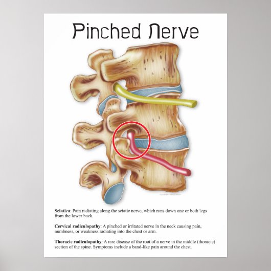 Pinched Nerve Physical Therapy Chiropractic Chart Poster (Voorkant)