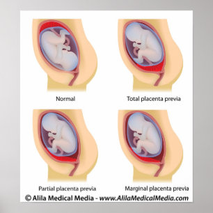 Placenta previa poster