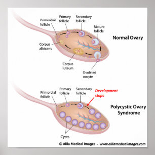 Polycysteus ovariumsyndroom, met een schema. poster