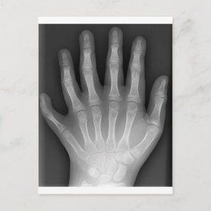 Polydactyly, Six Fingered Hand, X-Ray, zeldzaamhei Briefkaart