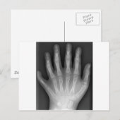 Polydactyly, Six Fingered Hand, X-Ray, zeldzaamhei Briefkaart (Voorkant / Achterkant)