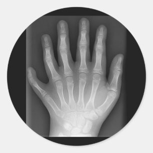 Polydactyly, Six Fingered Hand, X-Ray, zeldzaamhei Ronde Sticker