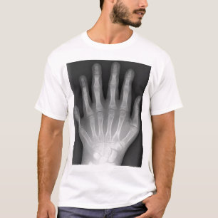 Polydactyly, Six Fingered Hand, X-Ray, zeldzaamhei T-shirt