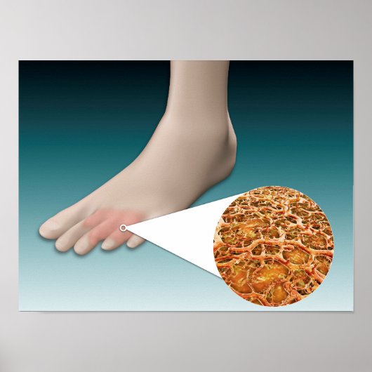 Poster Anatomie Des Fungus Pieds Avec Agrandissement Micr (Devant)