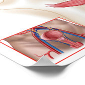 Poster Anatomie Du Glande Prostate (Coin)