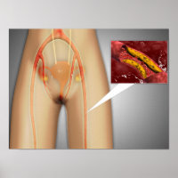 Artère étroite près de la jambe Gros plan