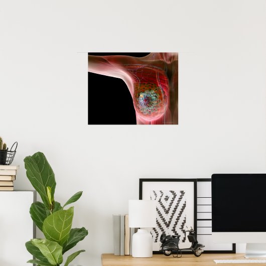 Poster Cancer du sein 2 (Bureau à domicile)