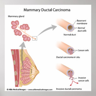 Poster Cancer du sein : carcinome ductal, schéma labellis