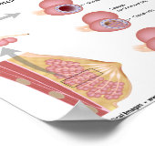 Poster Cancer du sein Lobulaire, diagramme étiqueté. (Coin)