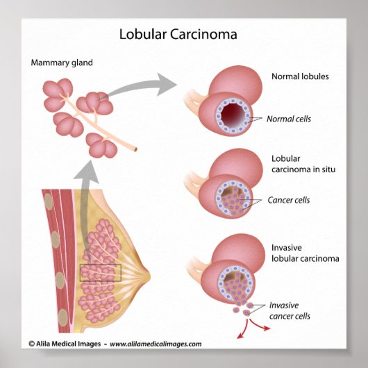 Poster Cancer du sein Lobulaire, diagramme étiqueté. (Devant)