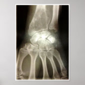 Poster Carpals Xray (Devant)