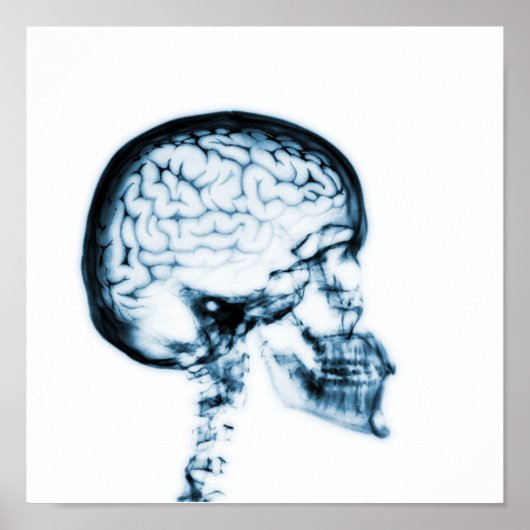 POSTER CERVEAU JUMEAU X-RAY - BLEU (Devant)