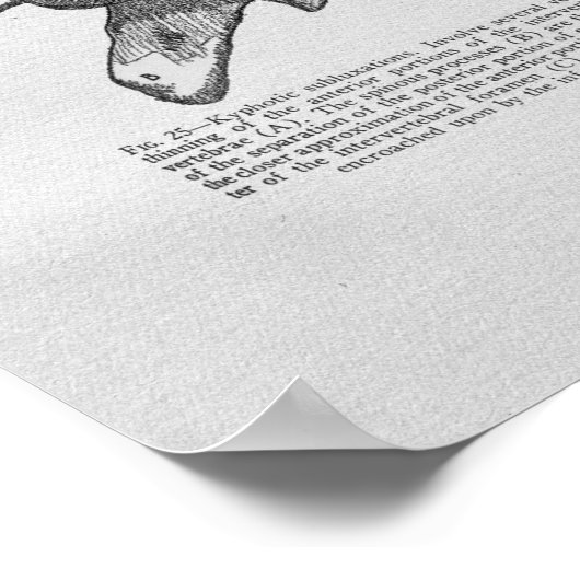 Poster Chiropractic Subluxation Vintage Print (Coin)