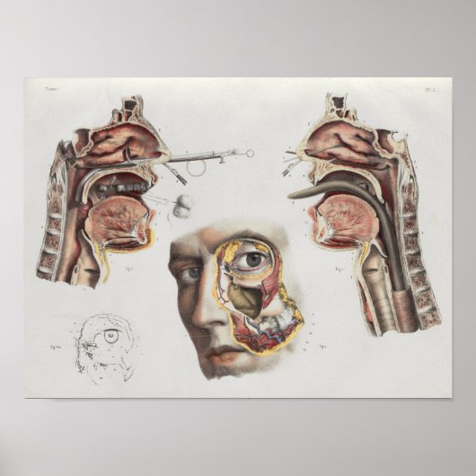 Poster Chirurgie Technique Médicale Anatomie Vintage Impr (Devant)