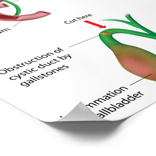Poster Cholecystectomie vésicule biliaire enlèvement chir (Coin)