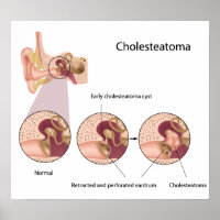 Poster Cholesteatoma tumeur de l'oreille moyenne