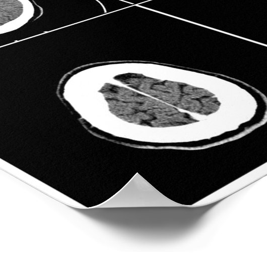 POSTER CT SCAN DE TÊTE (Coin)