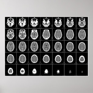 POSTER CT SCAN DE TÊTE