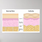 Poster de cellulite (Devant)