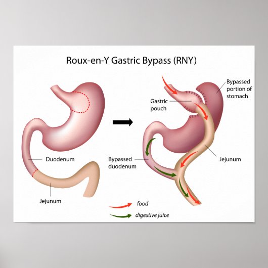 Poster de chirurgie de dérivation gastrique Roux-e (Devant)