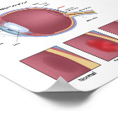 Poster de dégénérescence maculaire des yeux (Coin)