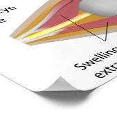 Poster de la maladie oculaire de Thyroid (Coin)