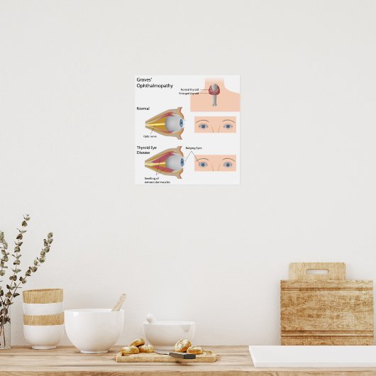 Poster de la maladie oculaire de Thyroid (Cuisine)