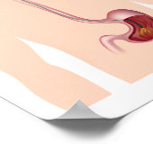 Poster de l'endoscopie IG supérieur (Coin)