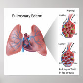 Poster de l'oedème pulmonaire (Devant)