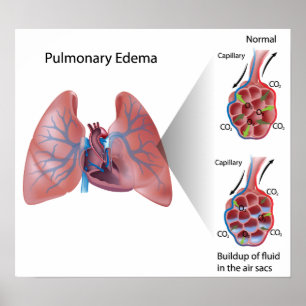 Poster de l'oedème pulmonaire