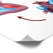 Poster de l'opération des valves cardiaques (Coin)