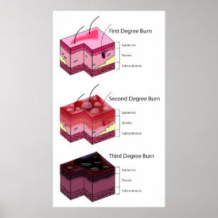 Poster De peau de brûlure de deuxième d'abord diagramme
