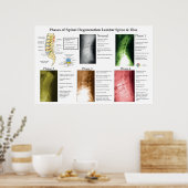 Poster Dégénérescence de la colonne lombaire Chiropratiqu (Cuisine)