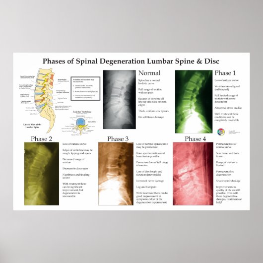 Poster Dégénérescence de la colonne lombaire Chiropratiqu (Devant)