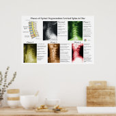 Poster Dégénérescence de la colonne vertébrale cervicale (Cuisine)