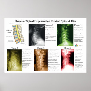Poster Dégénérescence de la colonne vertébrale cervicale