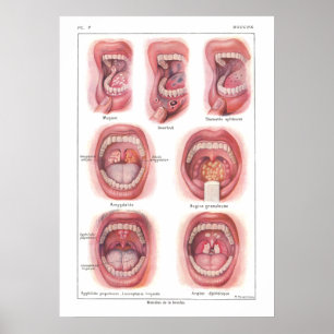 Poster des maladies de la bouche Anatomie Français