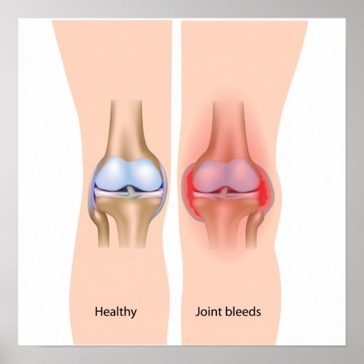 Poster des saignements communs en hémophilie (Devant)