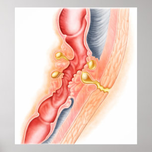 Poster Développement de fistule