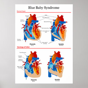 Poster Diagramme cardiaque anatomique du syndrome du bébé