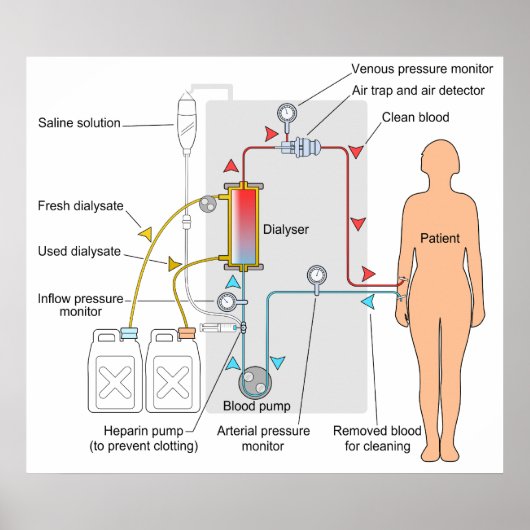 Poster Diagramme d'un traitement Médicale d'hémodialyse (Devant)