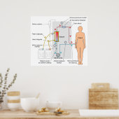 Poster Diagramme d'un traitement Médicale d'hémodialyse (Cuisine)