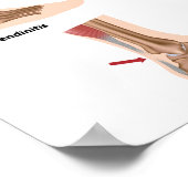 Poster Douleur de pied Achilles problèmes de tendon Poste (Coin)